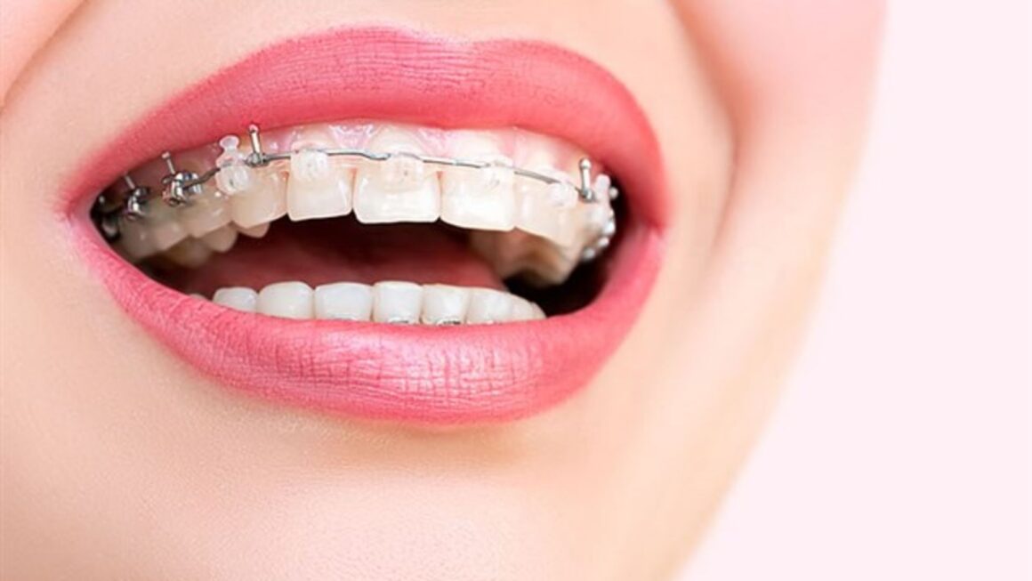 Diş teli tedavisinde dikkat edilmesi gerekenler nelerdir?